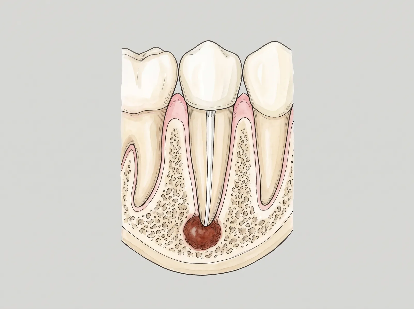 Cross-section illustration of a premolar with a lesion at the root tip — The infection that did not clear