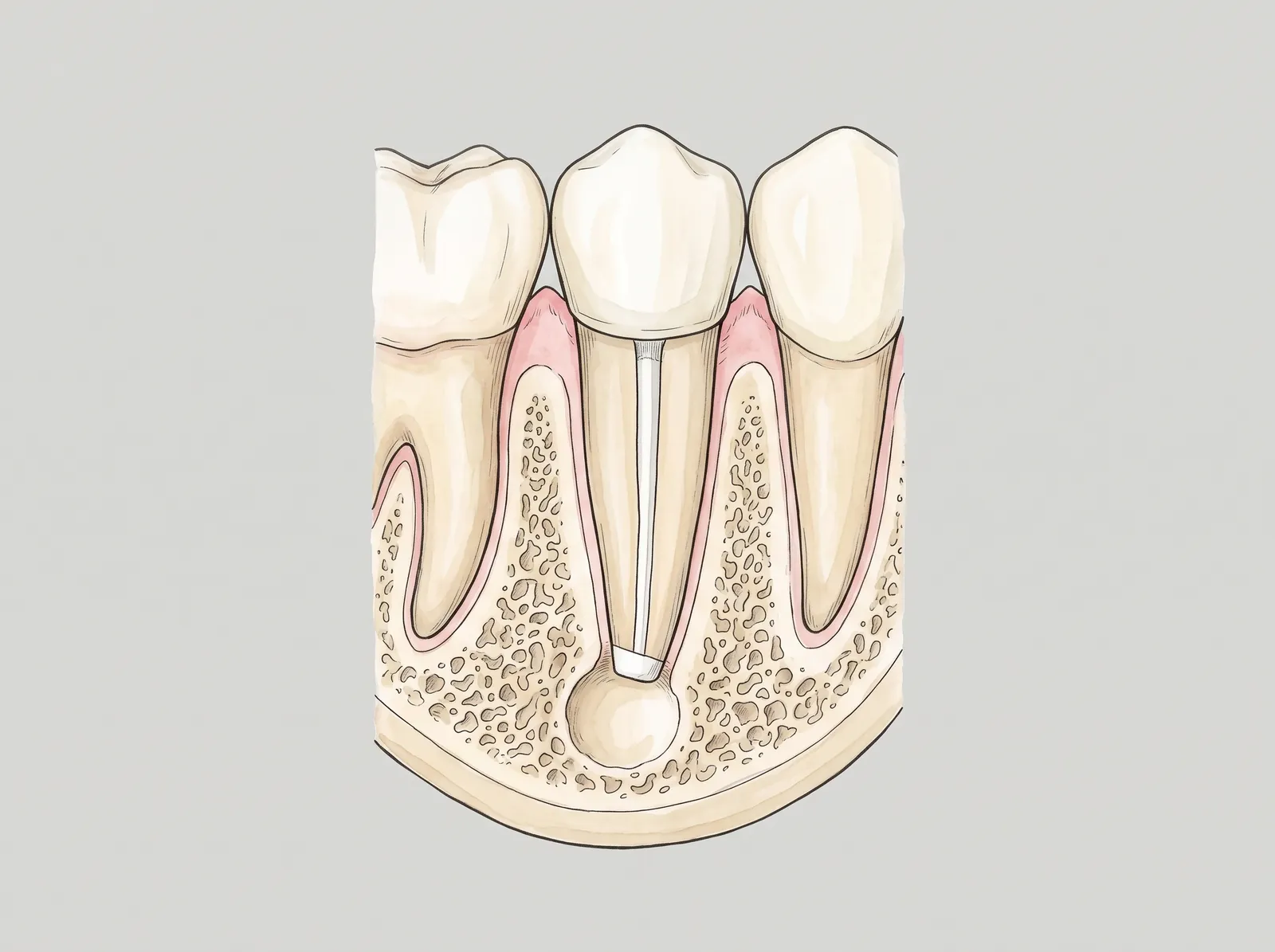 Cross-section illustration of a premolar with a lesion at the root tip — The lesion is removed and the root sealed