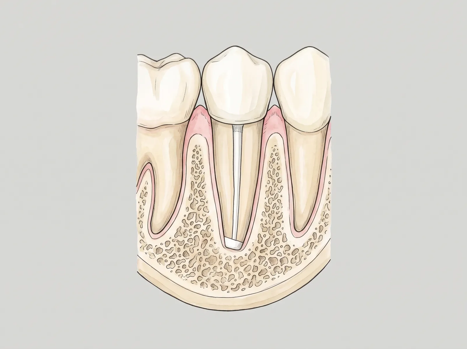 Cross-section illustration of a premolar with a lesion at the root tip — Months later: new bone